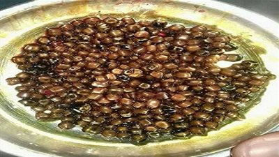 طبيب يُخرج 475 حصاة من مرارة سيدة مصرية