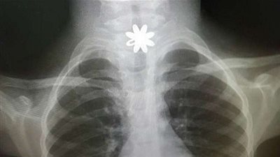 العثور على قطعة من الذهب في مريء طفلة