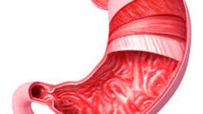 طبيب: 70% من المصريين مصابين بميكروب المعدة الحلزوني