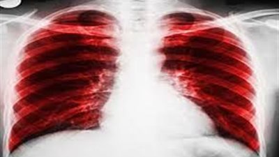 الانسداد الرئوي المزمن.. مرض خفي ولكنه فتاك، فاحذر