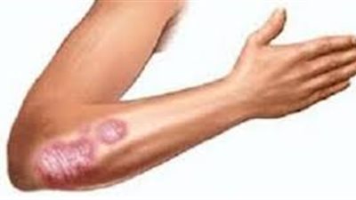 نصائح صحية للعناية بالجلد المصاب بالصدفية في أثناء فصل الشتاء !