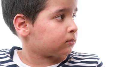 توصيات بفحص جلد الأطفال جيدا خلال الشتاء