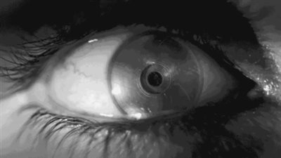 عيون إلكترونية حيوية لعلاج المصابين بالعمى في بريطانيا