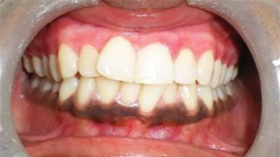 تحذير.. تغير لون اللثة دليل علي إصابتك بهذا المرض الخطير