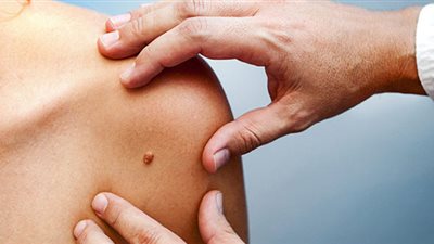 علاج جديد لسرطان الجلد ينقذ حياة الآلاف !