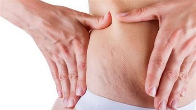 وصفة طبيعية تخلصك من مشكلة السيلوليت