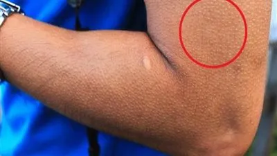 لهذا السبب يقشعر جلدك في الشتاء