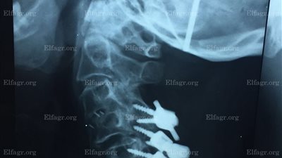 استئصال شريحة معدنية طولها 5 سم من مخيخ مريض داخل مستشفى بالإسكندرية 