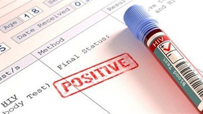 تجارب ناجحة على الأجسام المضادة لعلاج الإيدز تحد من انتشاره