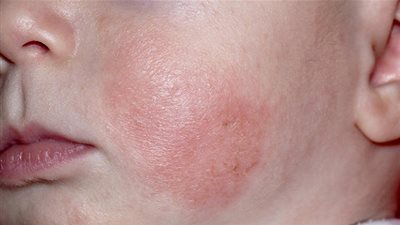 طرق التعامل مع الطفل المصاب بالإكزيما