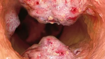 إنتشار مرض جديد أفتك من الإيدز.. أخطر ما قد يسببه عنق الرحم الخبيث !