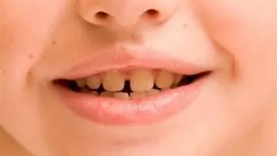 10 أطعمة ومشروبات تؤدي إلى اصفرار أسنانك.. تعرف عليها !