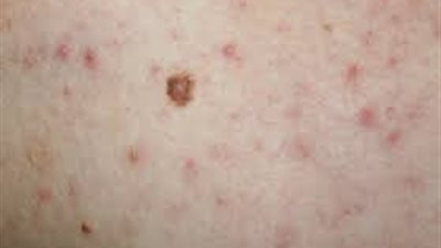احذري.. تغير شكل الوحمة ينذر بسرطان الجلد