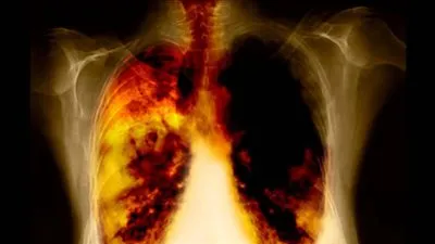 في 3 أيام فقط.. كيف تنظف رئتيك من سموم التدخين ؟