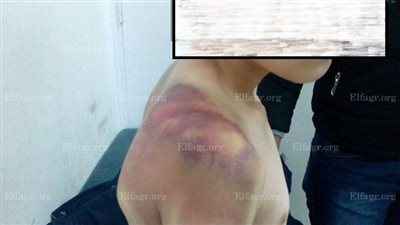 حرقت جسده بالماء المغلي.. 