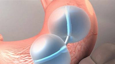 الأغذية تحذر من البالونات المملوءة بسائل داخل المعدة