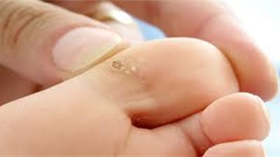 اليكِ هذه الوصفات البسيطة لعلاج الكالو في المنزل 