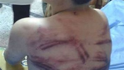 تقرير الطب الشرعي يثبت تعرض 