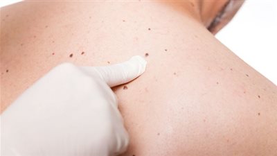 كيف تفرقون بين الشامة الحميدة والخبيثة؟