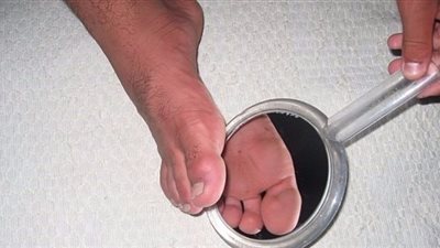 دراسة توصي مريض السكري بفحص القدمين كل ليلة