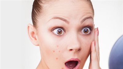 وصفات منزلية للتخلص سريعا من حبوب البشرة.. جربيها