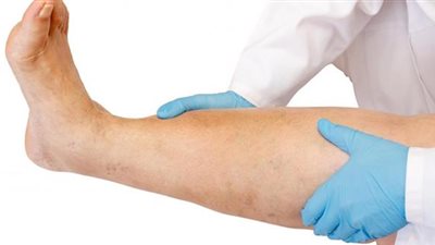 لحماية نفسك من الإصابة بجلطات الدم.. اتبع هذه النصائح