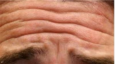 أصحاب تجاعيد الجبين معرضون للموت بأمراض قلبية