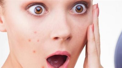 وصفة مذهلة للتخلص من حبوب الوجه نهائيا (فيديو)