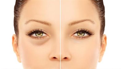 وصفات مجربة لعلاج انتفاخ العينين.. تعرفي عليها