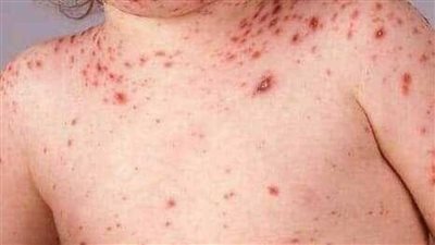 الصحة الجزائرية: الحصبة تقتل رضيعا وتصيب 20 آخرين