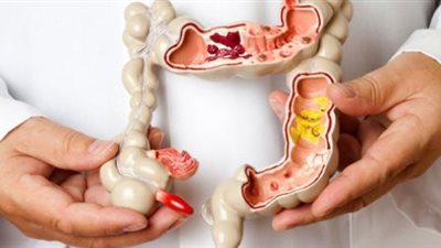 كيف تتخلص من انتفاخ القولون؟