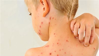 اليابان تسجل أعلى نسبة للحصبة منذ 2014