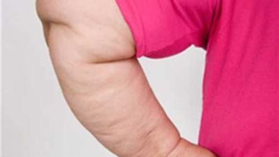 حقائق سريعة عن السيلوليت