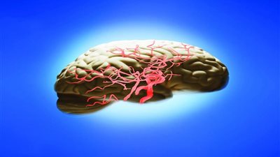 كيف تقين نفسكِ من السكتة الدماغية؟