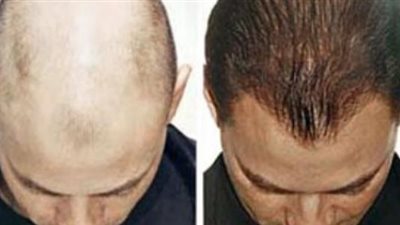 أطعمة تحارب الصلع وتمنع تساقط الشعر