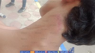 معلم يشوه جسم طالب بـ