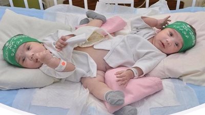 صدي - السعودية | بدء عملية فصل التوأم السيامي السعودي 