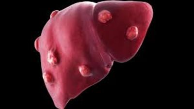 أعراض خطيرة تسبب سرطان الكبد.. اكتشفها