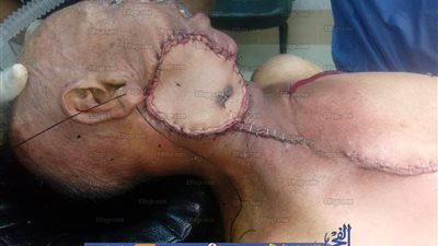 فريق طبي بمعهد جنوب مصر ينجح في استئصال ورم دقيق لمسن عمره  70 عاما