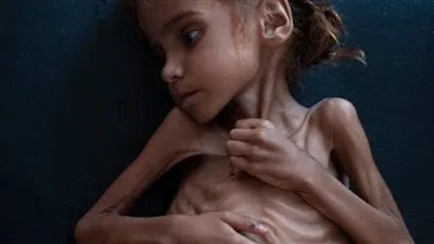 دول الأزماتXأسبوع.. الموت يختطف الطفلة أمل التي لفتت أنظار العالم للمجاعة في اليمن
