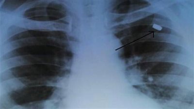 أصيب بها قبل 30 عاما.. أطباء يستخرجون رصاصة من صدر رجل!