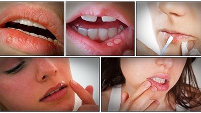 5 وصفات طبيعية تخلصك من 