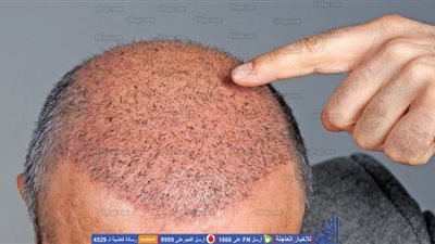 خمس نقاط توضّح لك كيفية اختيار العيادة الصحيحة لزراعة الشعر