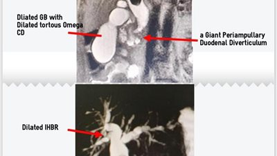 سبق – السعودية | مستشفى الملك سلمان بالرياض يجري عملية جراحية ناجحة لحالة نادرة 