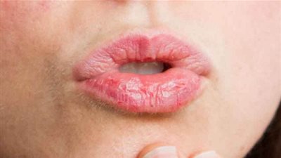 تعرفي على علاج 