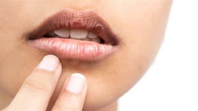 وصفة للتخلص من تشقق الشفاه في الشتاء (فيديو)