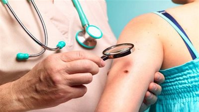 إليكِ طرق التعرف على الشامة السرطانية وكيفية علاجها!