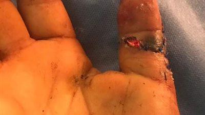 مستشفيات جامعة المنوفية تنجح في توصيل إصبع باليد اليمنى بعد بتره