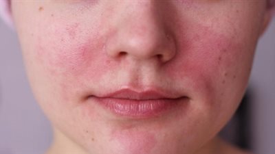 4 مكونات طبيعية يمكنها تهدئة التهاب البشرة بعد إزالة الشعر