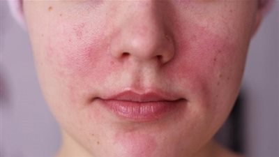 بعد إزالة الشعر.. مكونات طبيعية لتهدئة التهابات وتهيج البشرة 